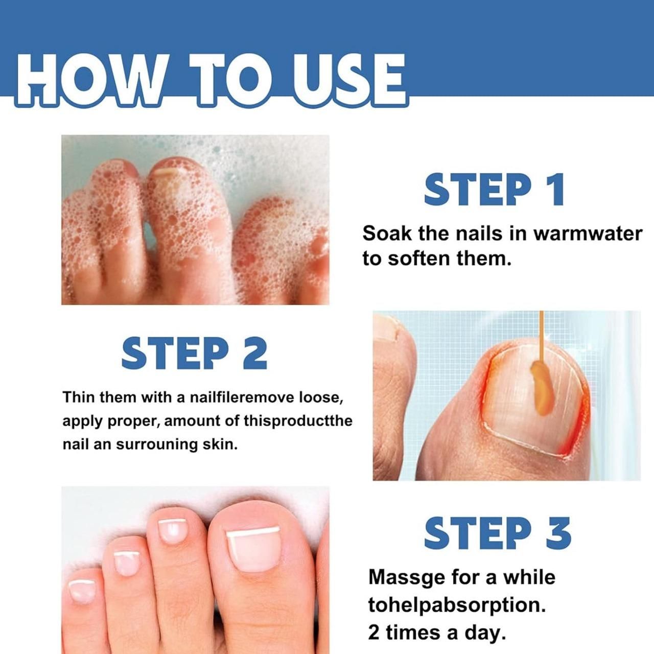 Nail Fungus Treatment Cream 100gm (Pack Of 1)