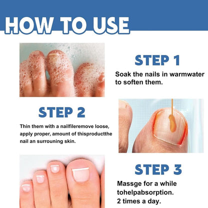 Nail Fungus Treatment Cream 100gm (Pack Of 1)