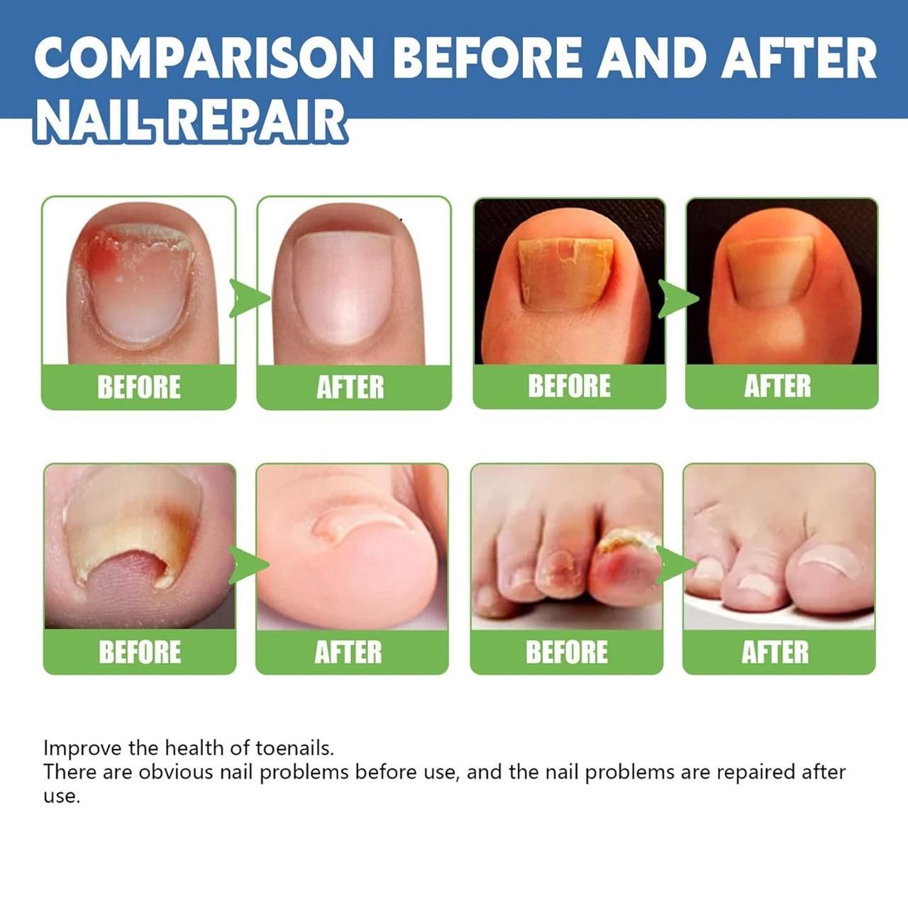 Nail Fungus Treatment Cream 100gm (Pack Of 1)