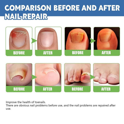 Nail Fungus Treatment Cream 100gm (Pack Of 1)